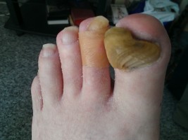 Fortykkede negle - før behandling